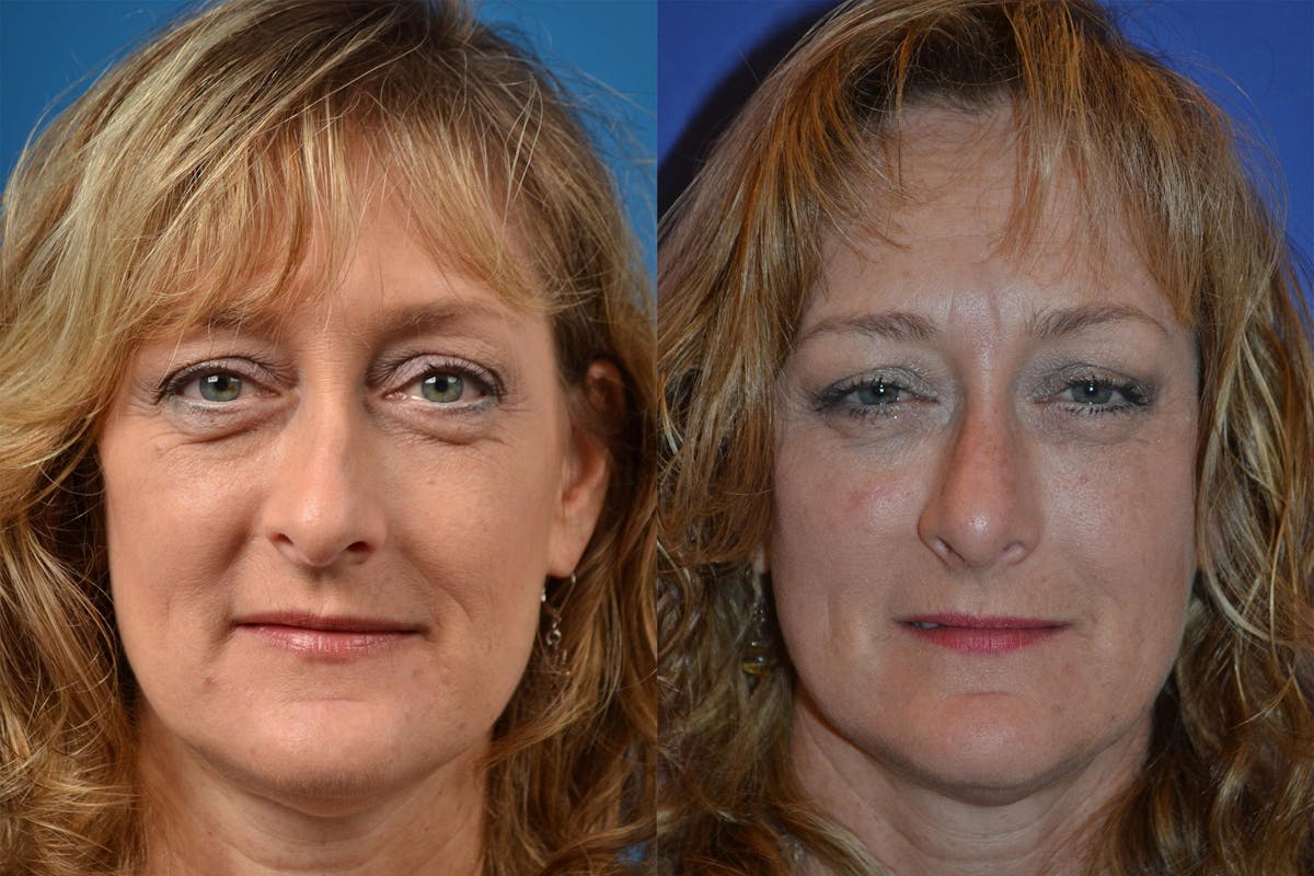 Rhinoplasty Before & After Gallery - Patient 122406836 - Image 1