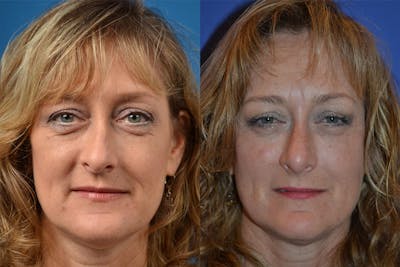 Rhinoplasty Before & After Gallery - Patient 122406836 - Image 1