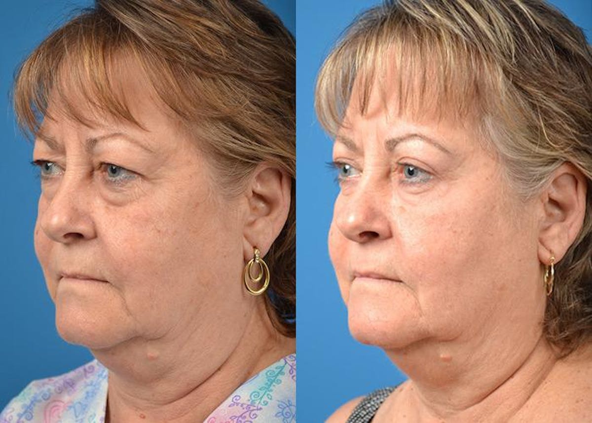 Skin Resurfacing Before & After Gallery - Patient 122406827 - Image 3