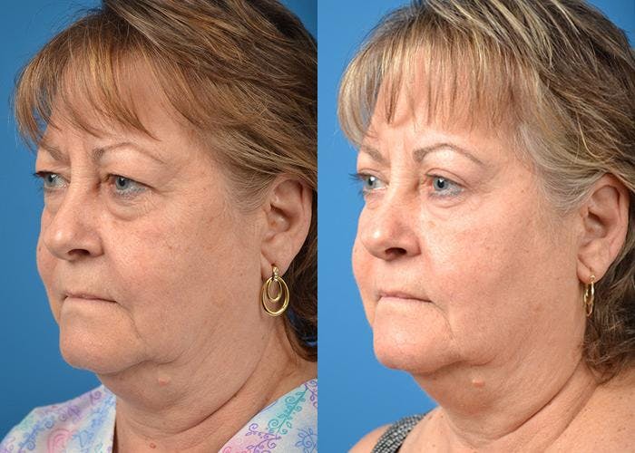 Skin Resurfacing Before & After Gallery - Patient 122406827 - Image 3