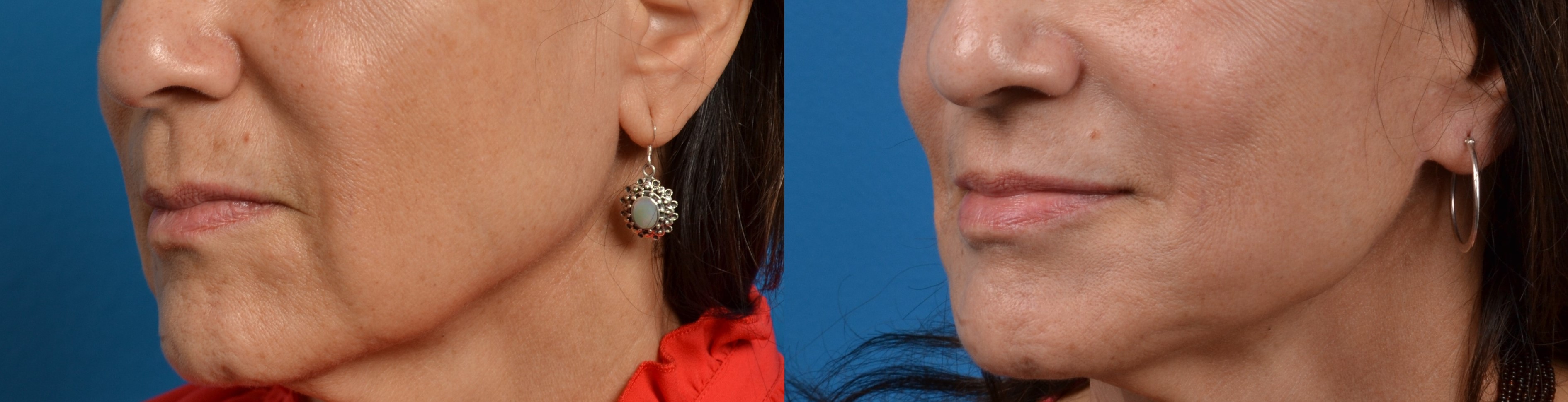 Lip Lift Before & After Gallery - Patient 122406828 - Image 3