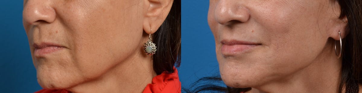 Lip Lift Before & After Gallery - Patient 122406828 - Image 3