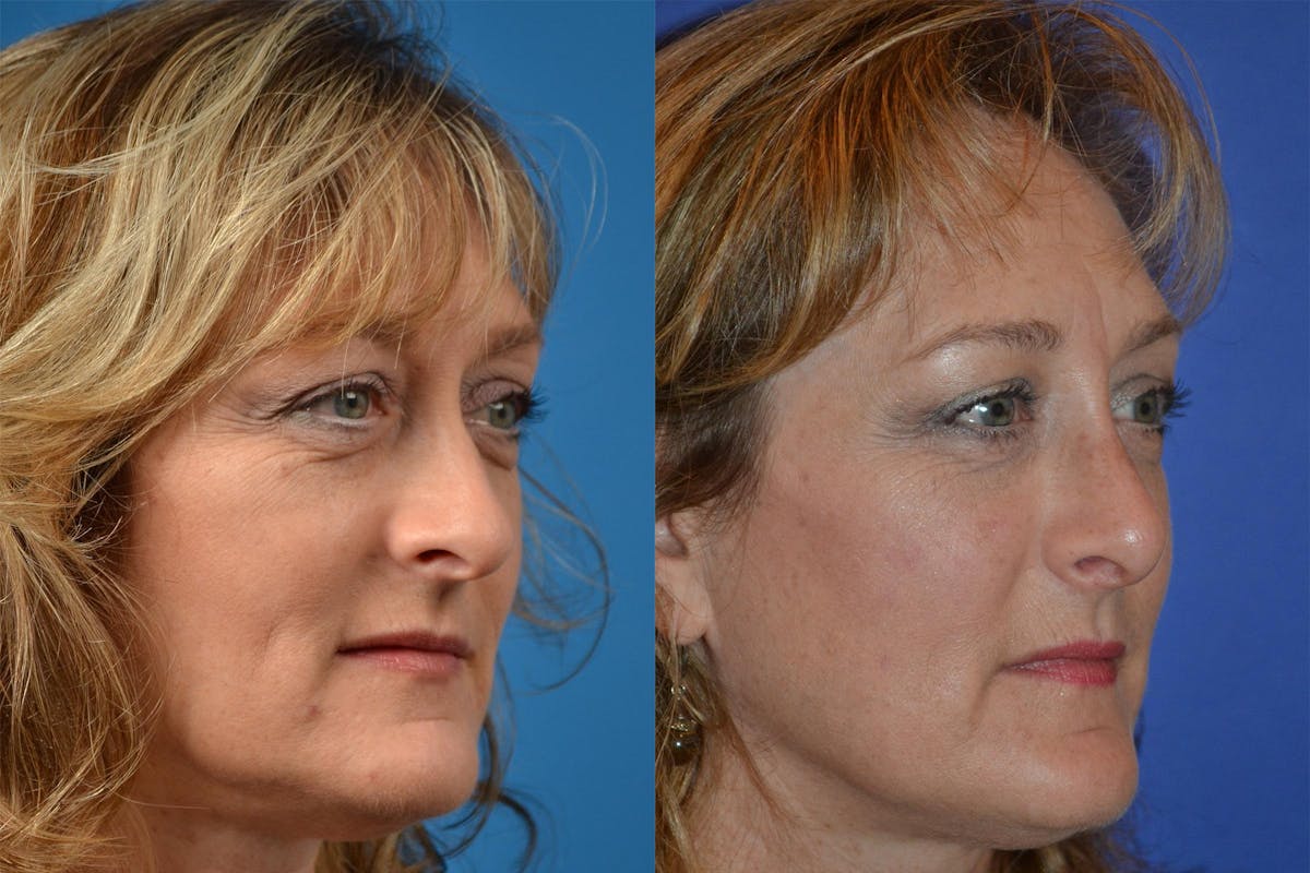 Rhinoplasty Before & After Gallery - Patient 122406836 - Image 2