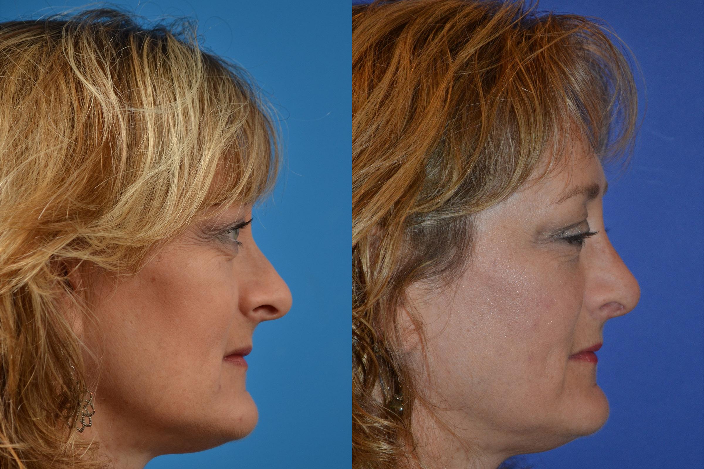 Rhinoplasty Before & After Gallery - Patient 122406836 - Image 3