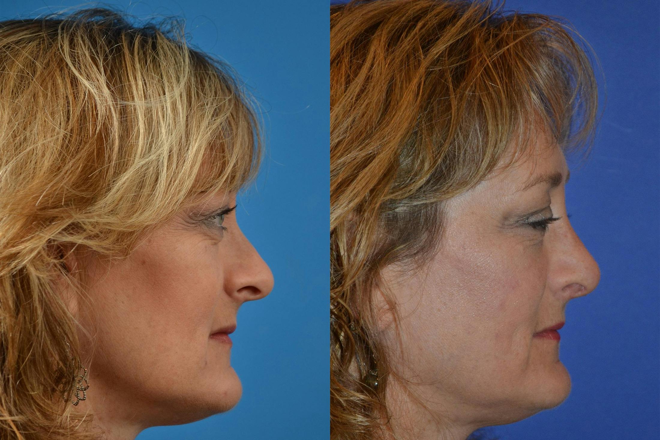 Rhinoplasty Before & After Gallery - Patient 122406836 - Image 3