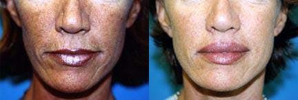Lip Lift Before & After Gallery - Patient 122406829 - Image 1