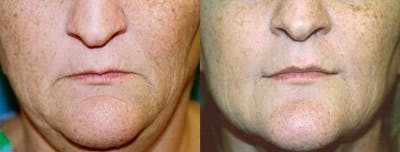 Lip Lift Before & After Gallery - Patient 122406830 - Image 1