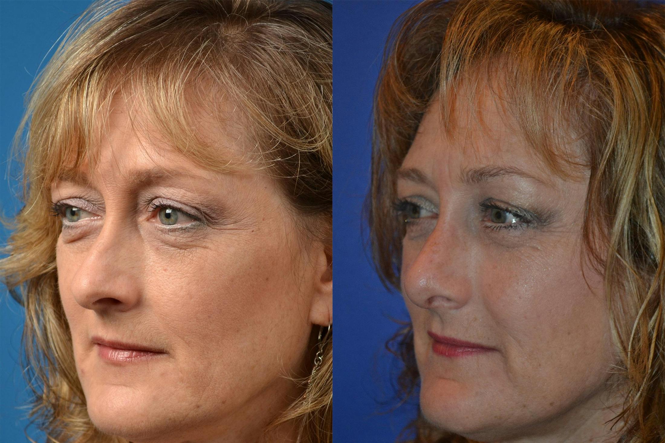 Rhinoplasty Before & After Gallery - Patient 122406836 - Image 4