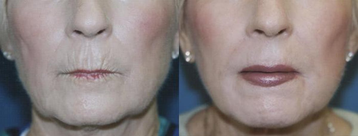 Lip Lift Before & After Gallery - Patient 122406833 - Image 1