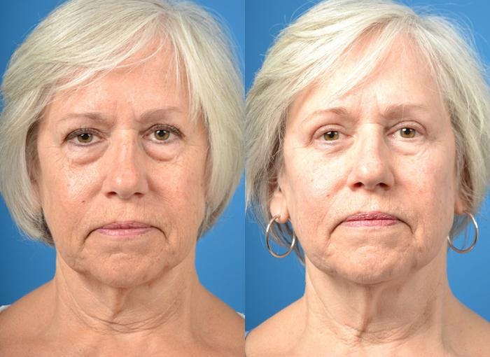 Skin Resurfacing Before & After Gallery - Patient 122406835 - Image 1