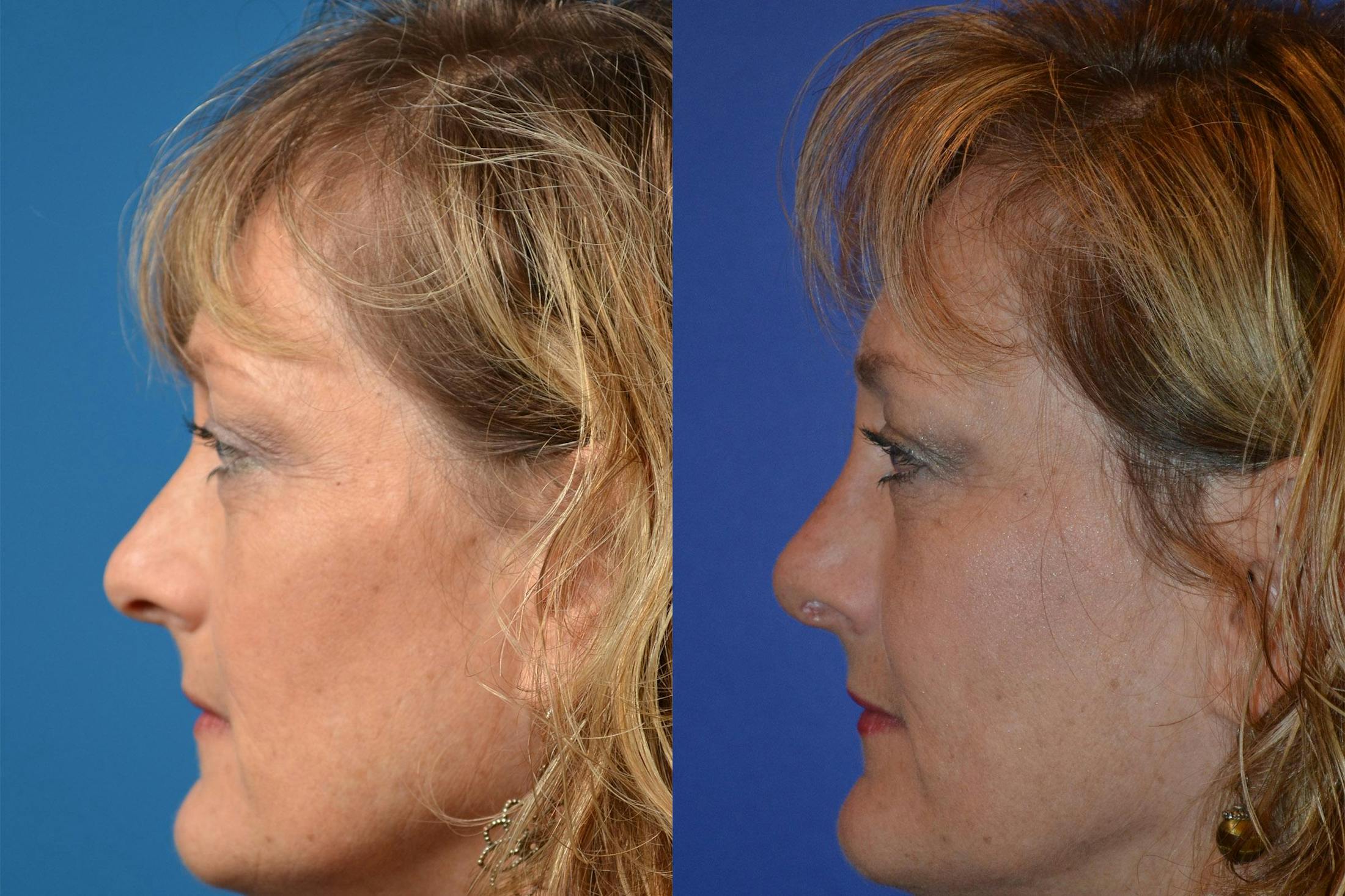 Rhinoplasty Before & After Gallery - Patient 122406836 - Image 5