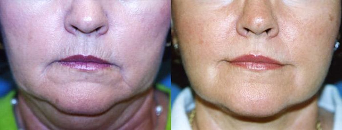 Lip Lift Before & After Gallery - Patient 122406834 - Image 1