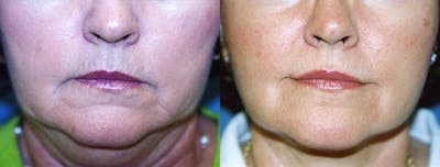 Lip Lift Before & After Gallery - Patient 122406834 - Image 1