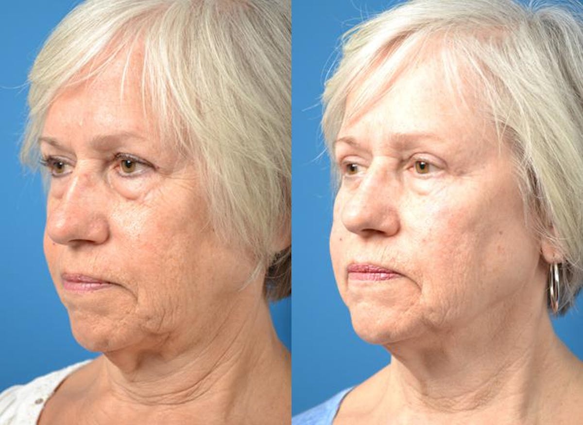 Skin Resurfacing Before & After Gallery - Patient 122406835 - Image 2