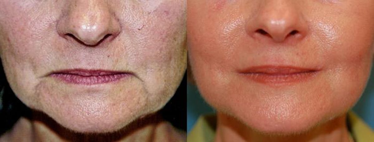 Lip Lift Before & After Gallery - Patient 122406837 - Image 1
