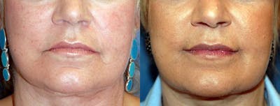 Lip Lift Before & After Gallery - Patient 122406838 - Image 1