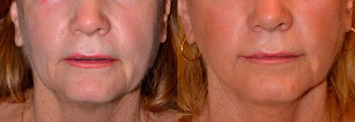 Lip Lift Before & After Gallery - Patient 122406840 - Image 1