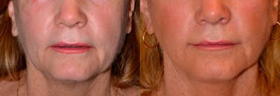 Lip Lift Before & After Gallery - Patient 122406840 - Image 1