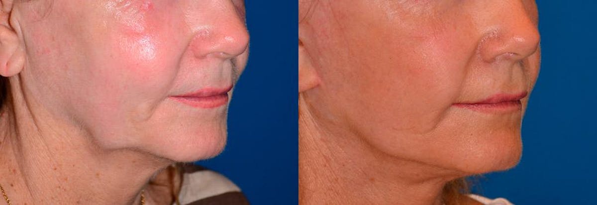 Lip Lift Before & After Gallery - Patient 122406840 - Image 2
