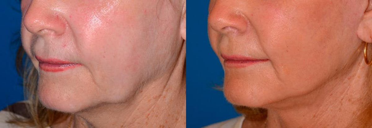 Lip Lift Before & After Gallery - Patient 122406840 - Image 3