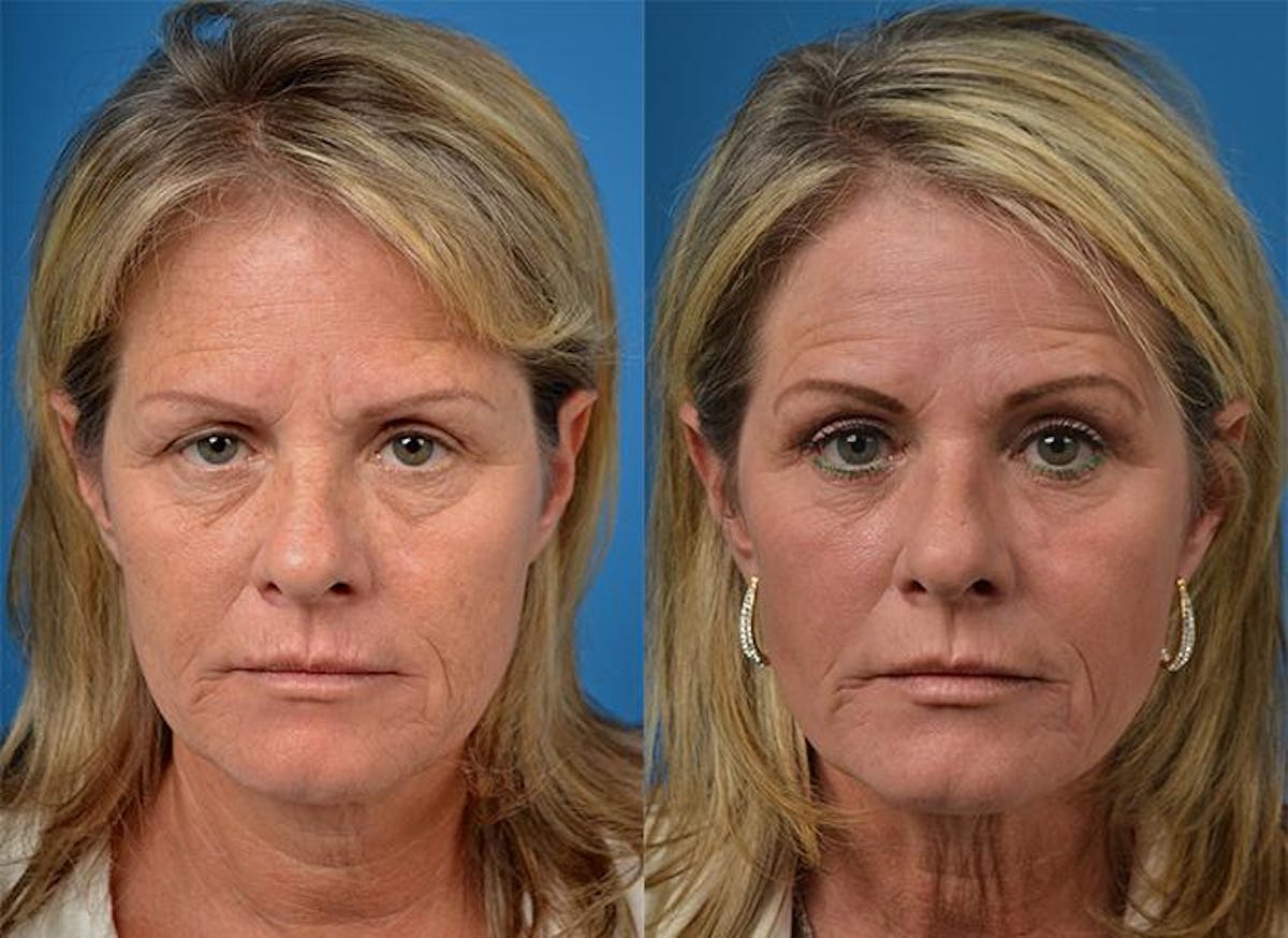 Skin Resurfacing Before & After Gallery - Patient 122406841 - Image 1