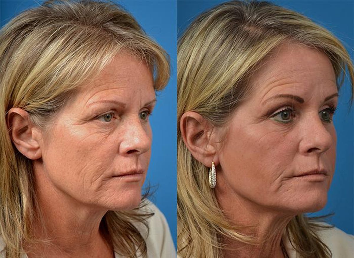 Skin Resurfacing Before & After Gallery - Patient 122406841 - Image 2