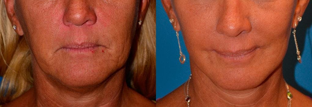 Lip Lift Before & After Gallery - Patient 122406842 - Image 1
