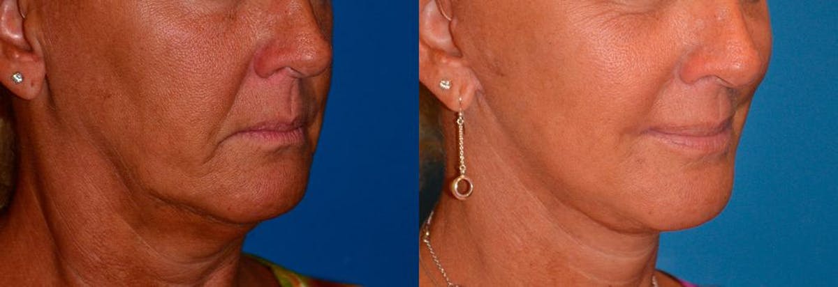 Lip Lift Before & After Gallery - Patient 122406842 - Image 2