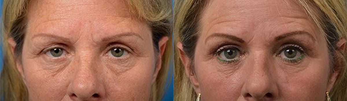 Skin Resurfacing Before & After Gallery - Patient 122406841 - Image 3