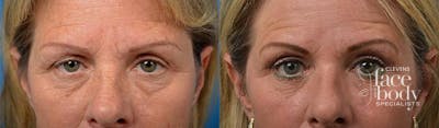 Eyelid Surgery Before & After Gallery - Patient 302591 - Image 1
