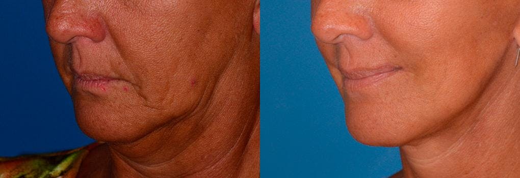 Lip Lift Before & After Gallery - Patient 122406842 - Image 3