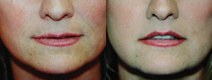 Lip Lift Before & After Gallery - Patient 122406843 - Image 1