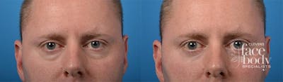Eyelid Surgery Before & After Gallery - Patient 132764 - Image 1