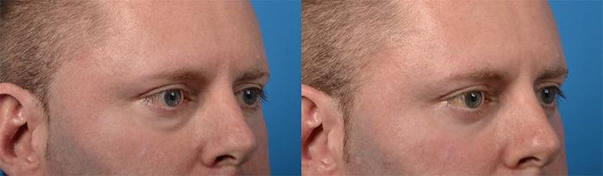Skin Resurfacing Before & After Gallery - Patient 122406845 - Image 2