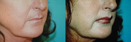 Lip Lift Before & After Gallery - Patient 122406846 - Image 1