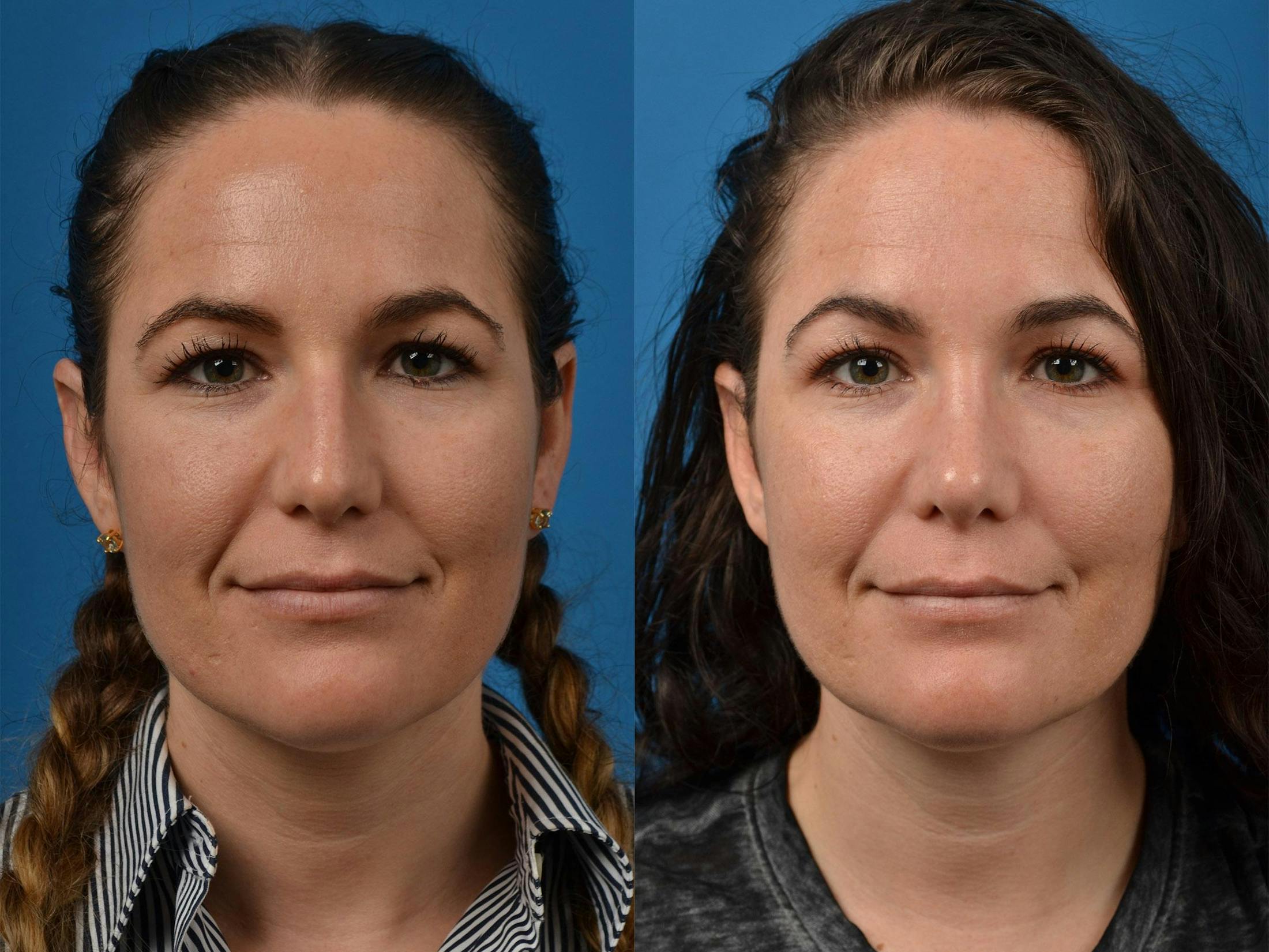 Rhinoplasty Before & After Gallery - Patient 122406854 - Image 1