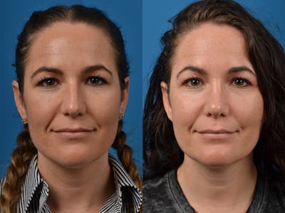 Rhinoplasty Before & After Gallery - Patient 122406854 - Image 1