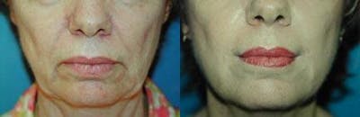 Lip Lift Before & After Gallery - Patient 122406848 - Image 1