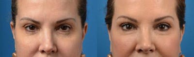 Skin Resurfacing Before & After Gallery - Patient 122406847 - Image 1