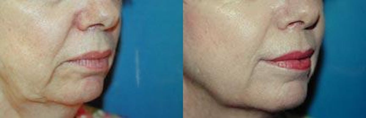 Lip Lift Before & After Gallery - Patient 122406848 - Image 2