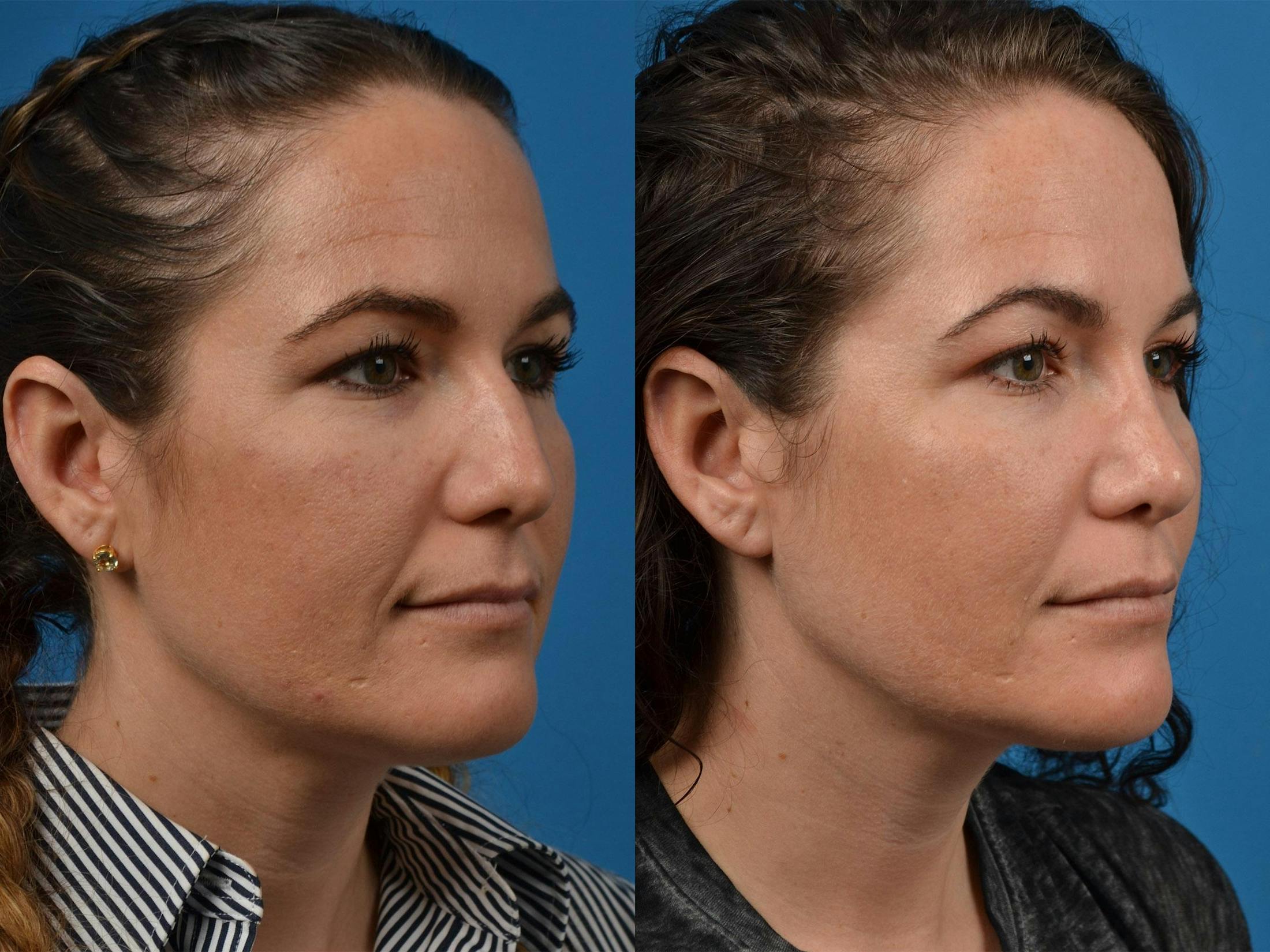 Rhinoplasty Before & After Gallery - Patient 122406854 - Image 2