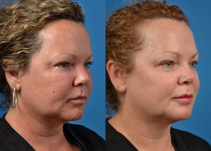 Skin Resurfacing Before & After Gallery - Patient 122406849 - Image 1