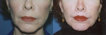 Lip Lift Before & After Gallery - Patient 122406850 - Image 1