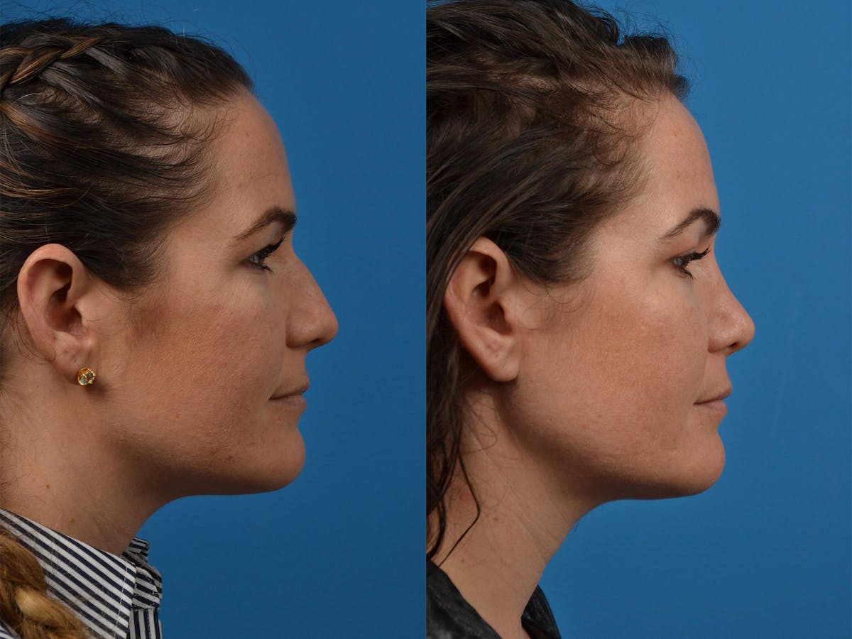 Rhinoplasty Before & After Gallery - Patient 122406854 - Image 3