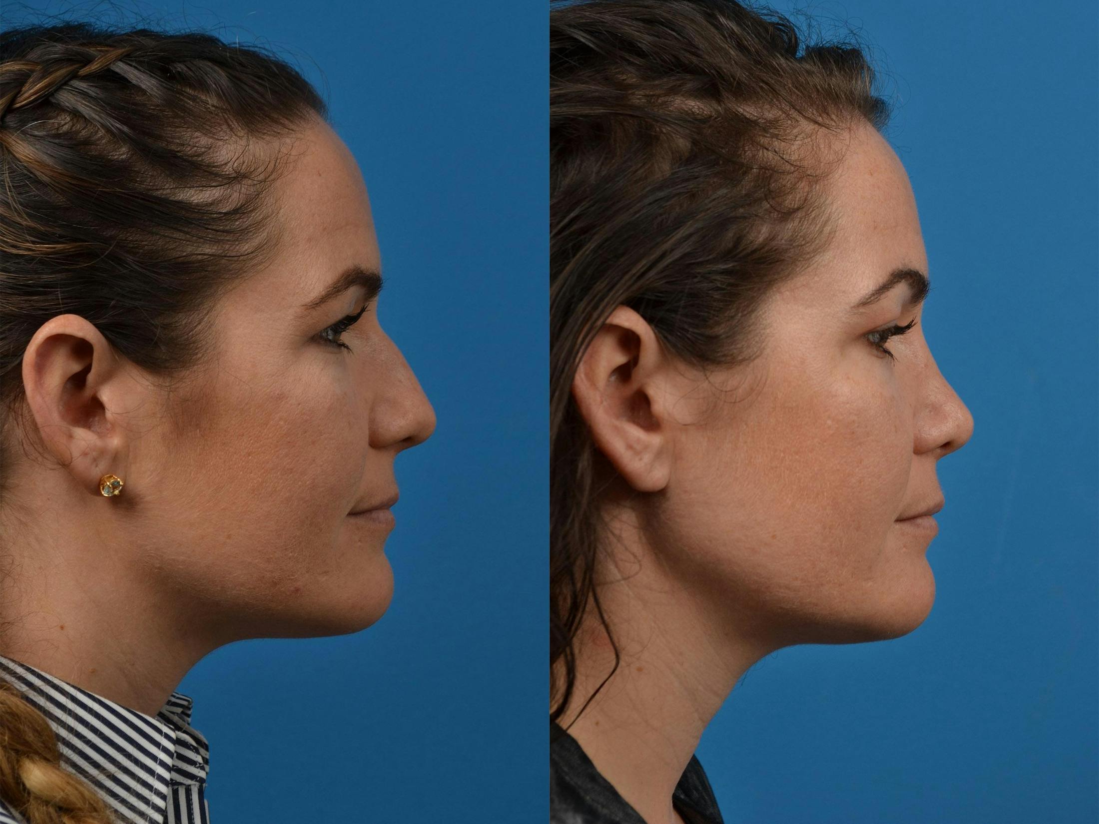 Rhinoplasty Before & After Gallery - Patient 122406854 - Image 3