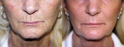 Lip Lift Before & After Gallery - Patient 122406851 - Image 1