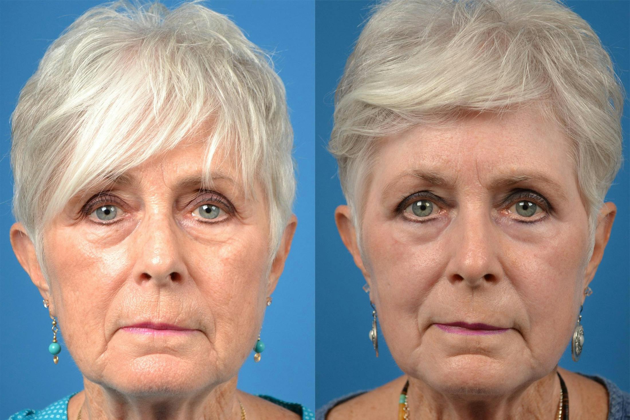 Skin Resurfacing Before & After Gallery - Patient 122406862 - Image 1
