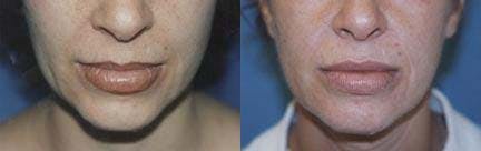 Lip Lift Before & After Gallery - Patient 122406852 - Image 1