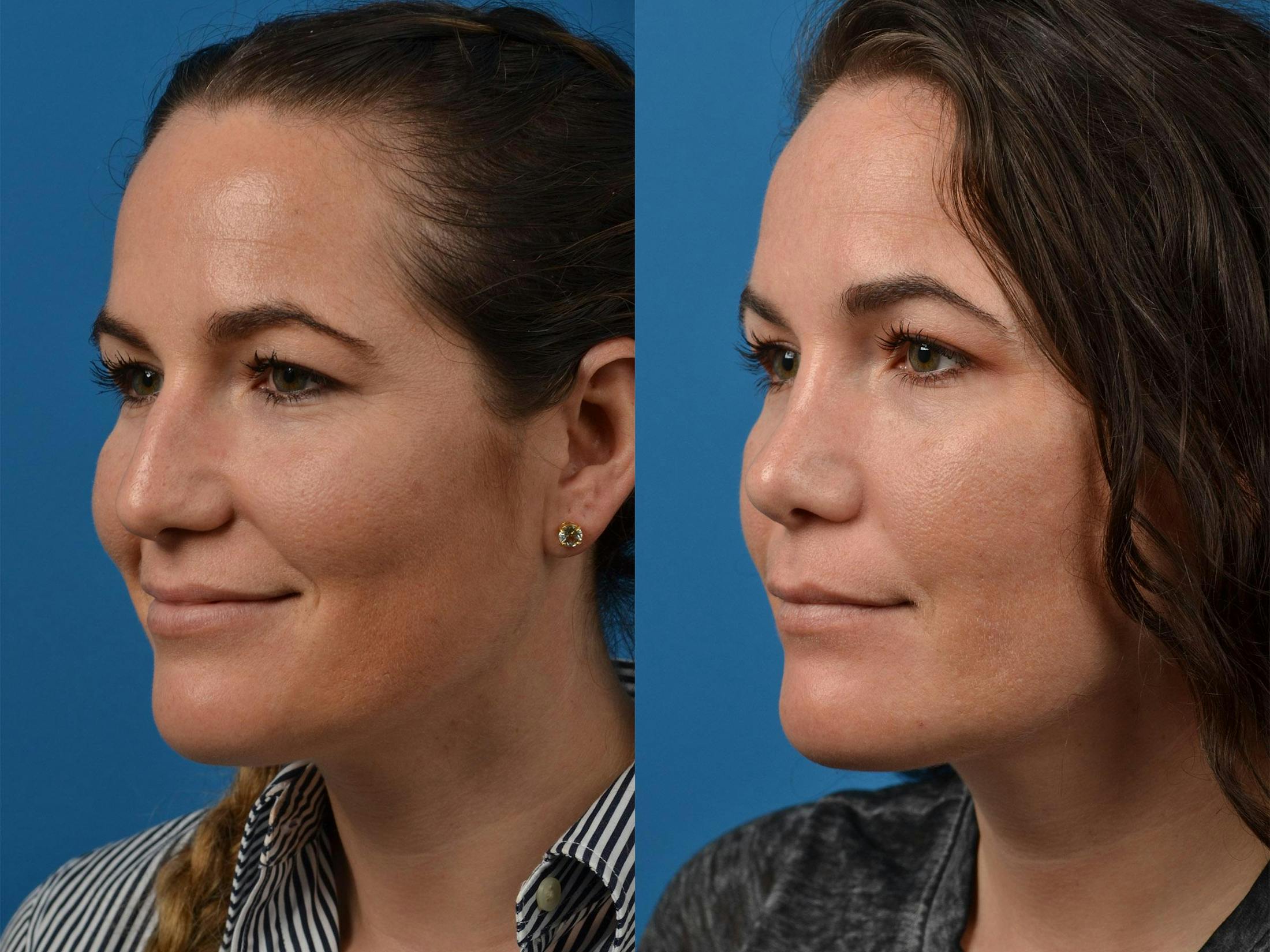Rhinoplasty Before & After Gallery - Patient 122406854 - Image 4