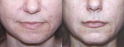 Lip Lift Before & After Gallery - Patient 122406853 - Image 1